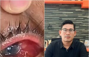 Warga Aceh Besar Diduga Alami Kebutaan Setelah Diberi Obat, YARA: Usut Sampai Tuntas