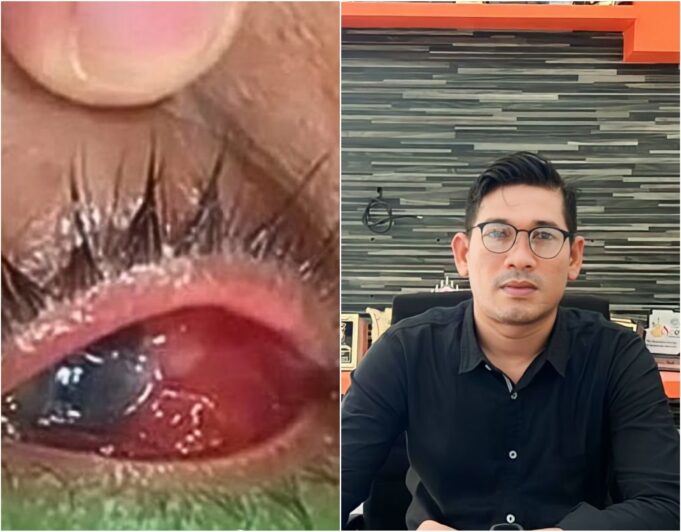 Warga Aceh Besar Diduga Alami Kebutaan Setelah Diberi Obat, YARA: Usut Sampai Tuntas