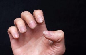 Kenali Penyebab Kuku Bergaris dan Cara Mengatasinya